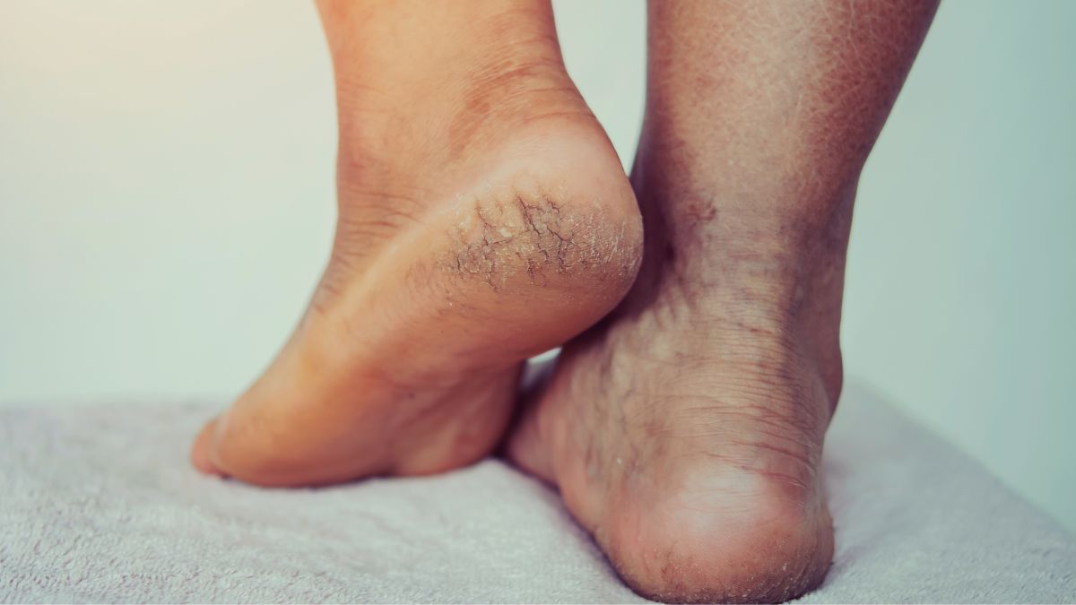 बारिश में पैरों की देखभाल: गंदे पानी से कटने और फटने लगे हैं पैर तो अपनाएं ये घरेलू नुस्खे