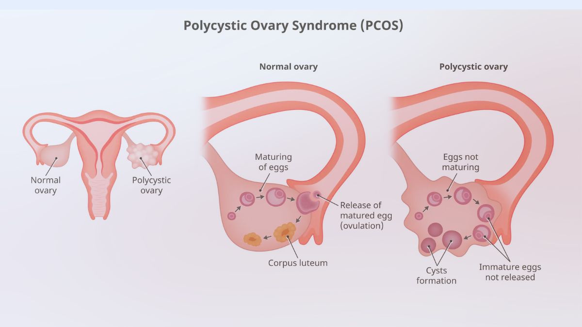 क्यों PCOD में झड़ते हैं सिर के बाल और शरीर पर उग आते हैं अनचाहे बाल