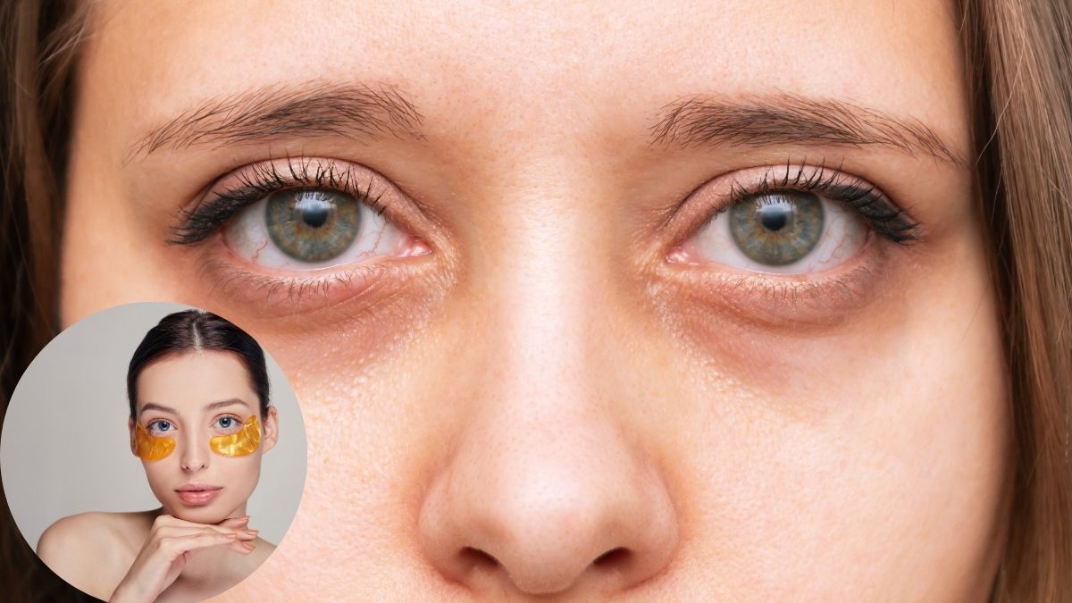 15 दिन में पाएं डार्क सर्कल से छुटकारा, बस अपनाएं केले के छिलके का ये आसान नुस्खा