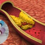Cholesterol: गुड और बैड कोलेस्ट्रॉल में क्या फर्क है, कितना होना चाहिए स्तर?