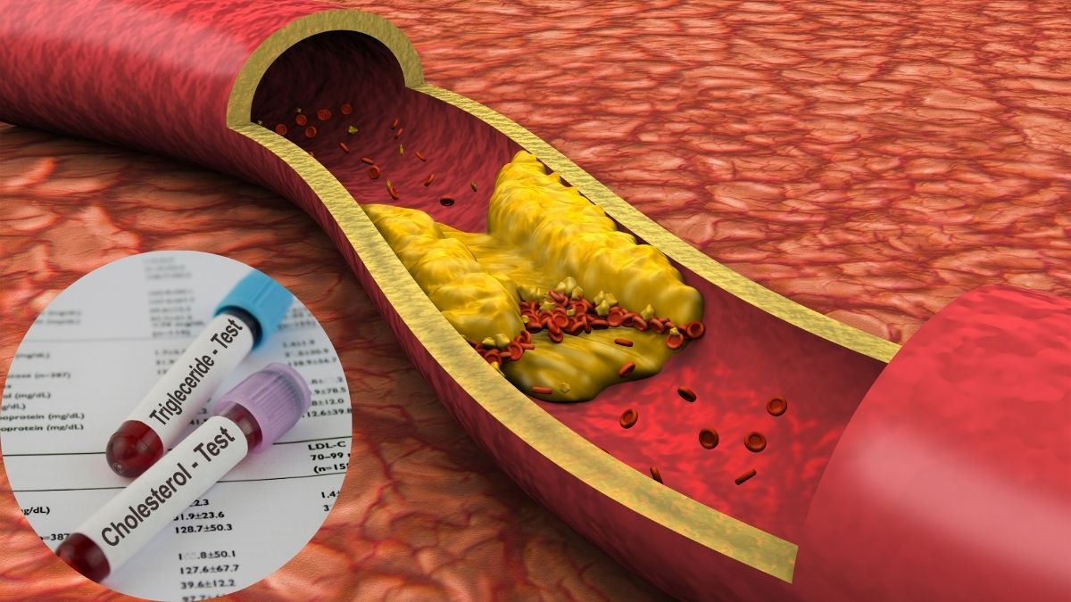 Cholesterol: गुड और बैड कोलेस्ट्रॉल में क्या फर्क है, कितना होना चाहिए स्तर?